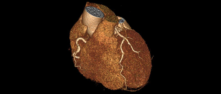 一項硬科技，讓CTA冠脈診斷方式徹底顛覆